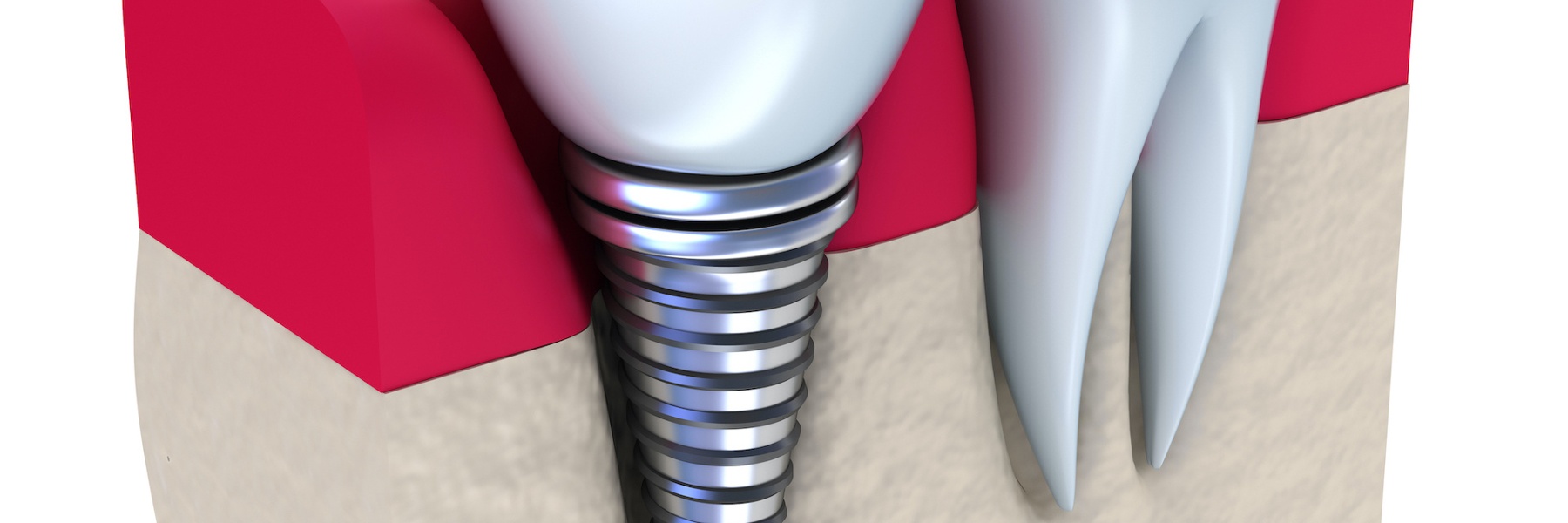 Diagram showing how a titanium dental implant fuses with the jawbone for stability